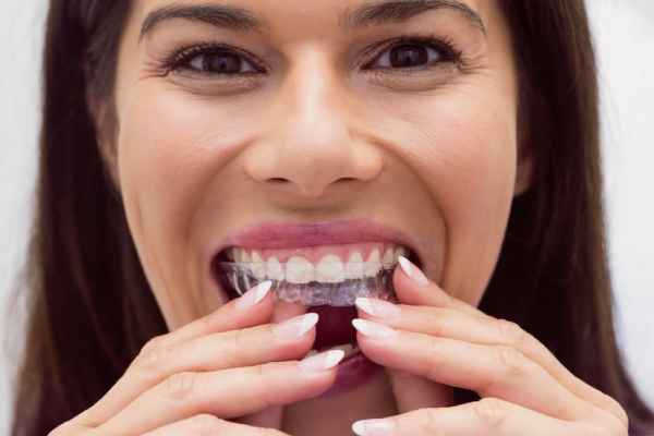 Clear-aligners-close-up